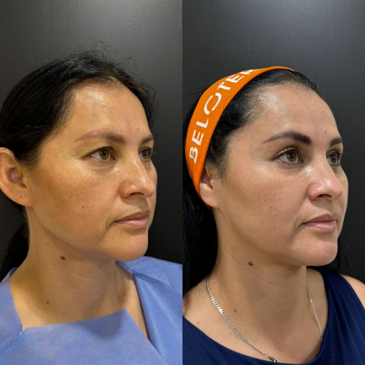 Facelift results at Dr. Alexandro Aguilera - Plastic Surgery