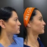 Результаты до и после подтяжки лица в Dr. Alexandro Aguilera - Plastic Surgery, улучшена линия подбородка
