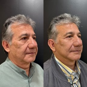 Результаты до и после фейслифтинга в Dr. Alexandro Aguilera - Plastic Surgery, омоложение лица