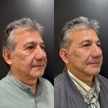 Результаты до и после фейслифтинга в Dr. Alexandro Aguilera - Plastic Surgery, омоложение лица