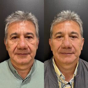 Результаты до и после фейслифтинга в Dr. Alexandro Aguilera - Plastic Surgery, омоложение лица