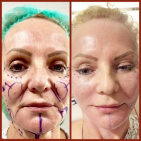 Before and after neck lift results at DGB Clinic, visible facial contour improvement