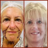 Before and after neck lift results at DGB Clinic, visible facial rejuvenation and smoother neck