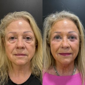 Vorher-nachher-Ergebnis Oberlidstraffung bei Dr. Alexandro Aguilera - Plastic Surgery