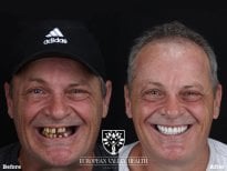 Résultat avant/après implants dentaires All-on-4 chez European Valley Health, sourire restauré