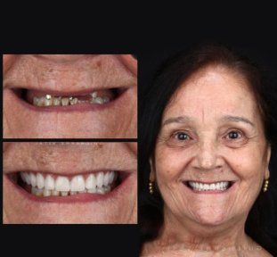Результат до та після імплантації All-on-4 у European Valley Health – відновлення усмішки