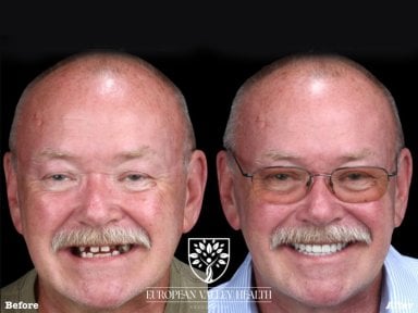 Résultat avant/après implants dentaires All-on-4 chez European Valley Health, sourire restauré