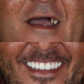 نتيجة قبل وبعد زراعة الأسنان All-on-4 في European Valley Health، استعادة الابتسامة