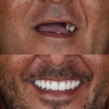 نتيجة قبل وبعد زراعة الأسنان All-on-4 في European Valley Health، استعادة الابتسامة