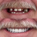 نتيجة قبل وبعد زراعة الأسنان All-on-4 في European Valley Health، ابتسامة مستعادة