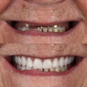 نتيجة قبل وبعد زراعة الأسنان All-on-4 في European Valley Health، استعادة الابتسامة