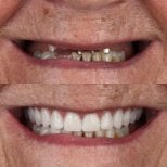 نتيجة قبل وبعد زراعة الأسنان All-on-4 في European Valley Health، استعادة الابتسامة