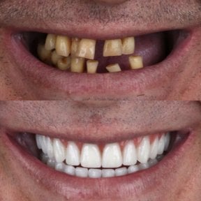 نتيجة قبل وبعد زراعة الأسنان All-on-4 في European Valley Health، استعادة الابتسامة