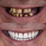 نتيجة قبل وبعد زراعة الأسنان All-on-4 في European Valley Health، استعادة الابتسامة