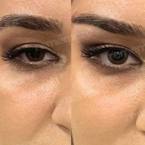Before and after Fox Eye Lift results at Memorial Şişli Hospital, lifted eyelid appearance