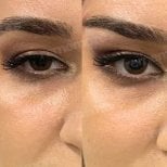 Before and after Fox Eye Lift results at Memorial Şişli Hospital, lifted eyelid appearance