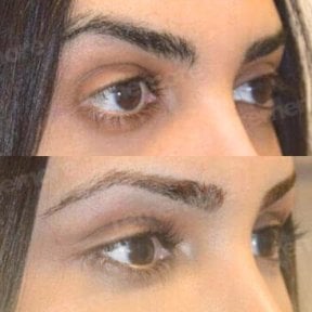 Before and after Fox Eye Lift results at Memorial Şişli Hospital, lifted eyelid appearance
