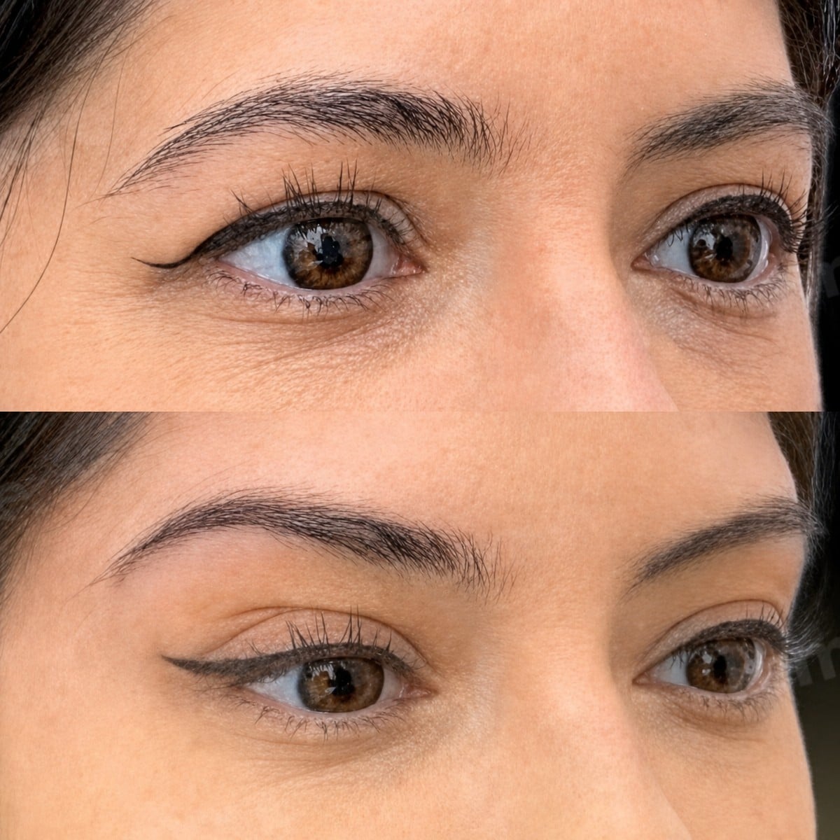 نتائج قبل وبعد Fox Eye Lift في مستشفى Memorial Şişli، مظهر جفن مرفوع