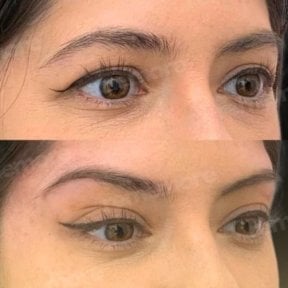 Before and after Fox Eye Lift results at Memorial Şişli Hospital, lifted eyelid appearance