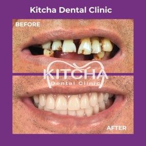 Before and after Straumann dental implants result at Kitcha Dental Clinic, smile restoration