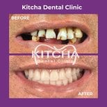 Before and after Straumann dental implants result at Kitcha Dental Clinic, smile restoration