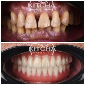 Before and after Straumann dental implants at Kitcha Dental Clinic, smile restoration results