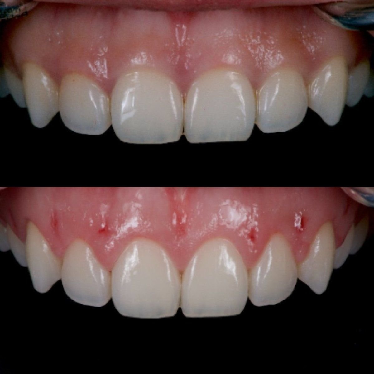 Resultados antes y después de cirugía de encías en Kitcha Dental Clinic, línea mejorada