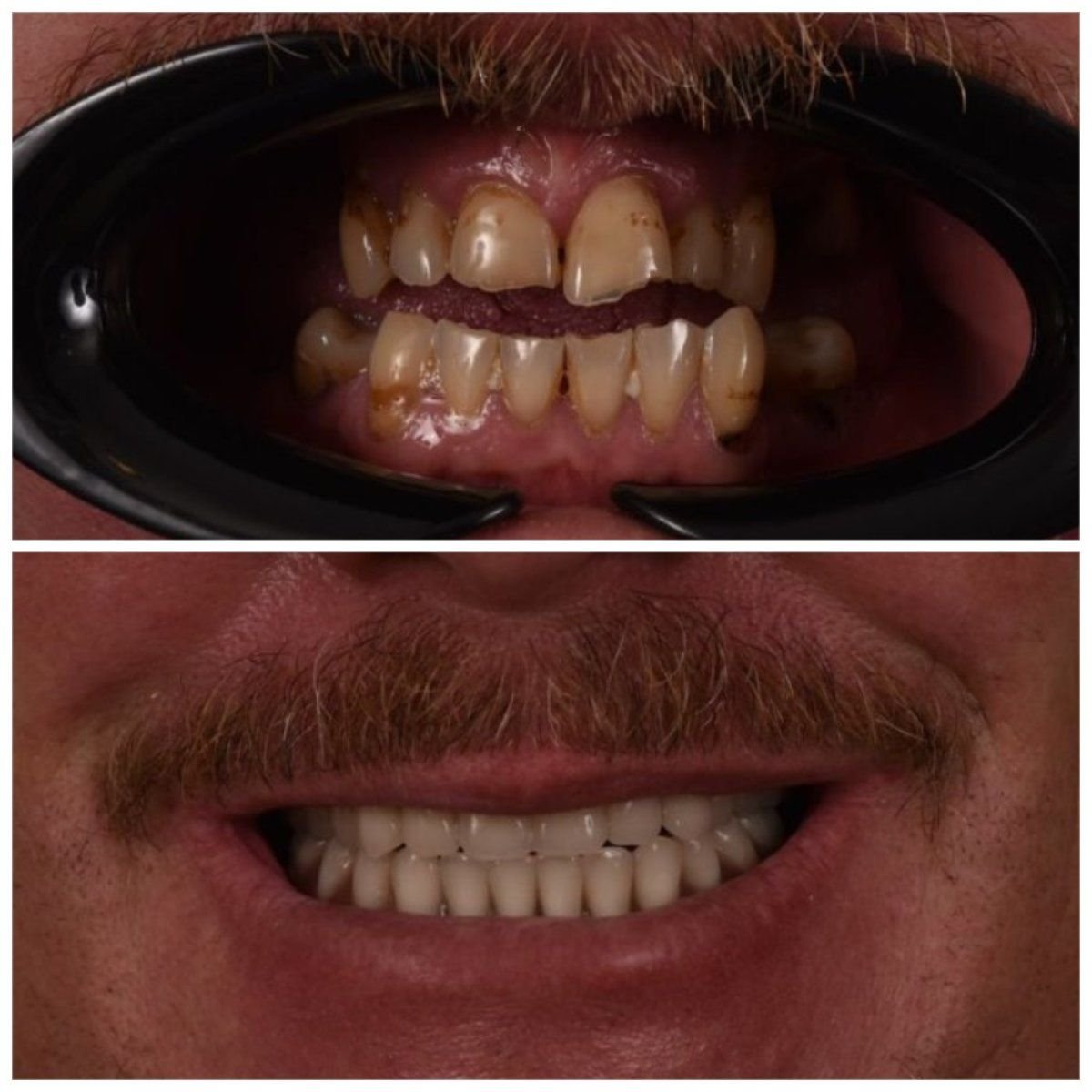 نتائج قبل وبعد استبدال تيجان الأسنان في عيادة Kitcha Dental Clinic، ابتسامة محسنة