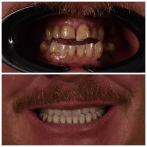 Vorher-nachher-Ergebnis Kronenersatz bei Kitcha Dental Clinic, verbesserte Zahnästhetik