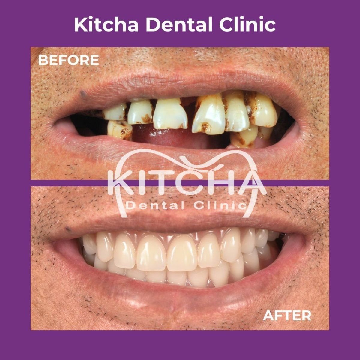 نتائج قبل وبعد استبدال تيجان الأسنان في عيادة Kitcha، ابتسامة مستعادة