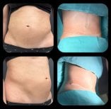 Before and after tummy tuck and liposuction results at VM Medical Park Florya Hospital
