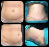Before and after tummy tuck and liposuction results at VM Medical Park Florya Hospital