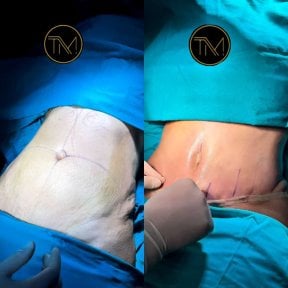Before and after tummy tuck and liposuction results at VM Medical Park Florya Hospital