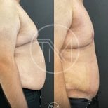 Before and after tummy tuck and liposuction results at VM Medical Park Florya Hospital