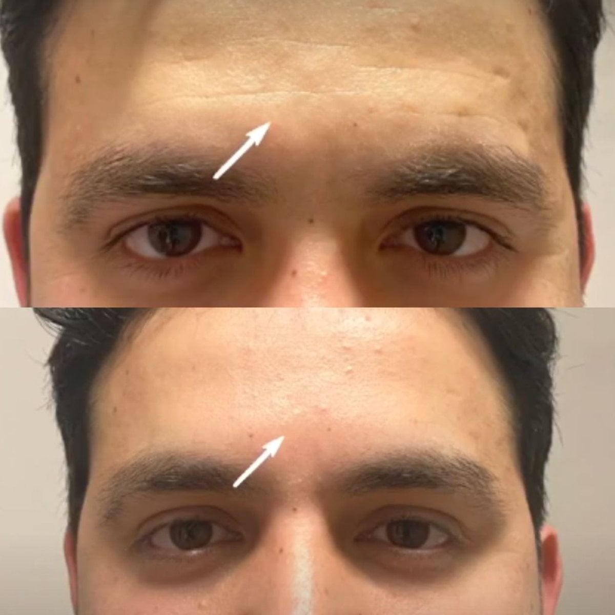 Antes y después de rellenos en Quartz Hospital, resultado de reducción de arrugas en la frente