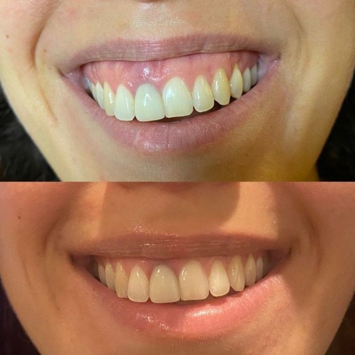 Antes y después de carillas dentales en Quartz Hospital, mejora estética de la sonrisa
