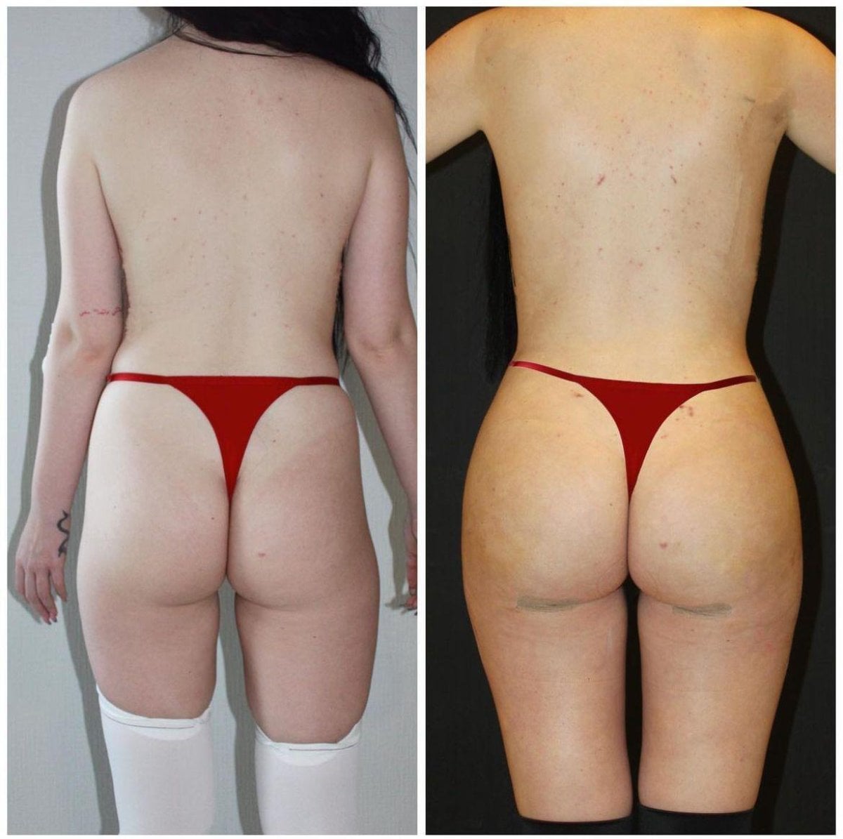 Resultados antes y después de Brazilian Butt Lift en Dr. Ilker Manavbasi's Clinic, curvas mejoradas