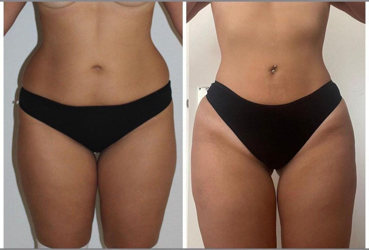 Resultados de liposucción antes y después en la clínica Dr. Ilker Manavbasi, contorno mejorado