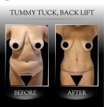 Fotos de antes e depois de Vaser 3 Áreas + Abdominoplastia pelo Dr. 