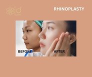 Before and after rhinoplasty results at ID Clinic Bangkok, nose reshaping with natural look