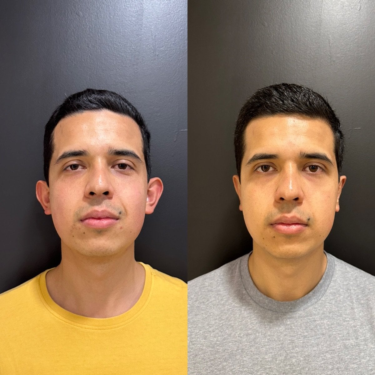 Resultados de otoplastia antes y después en Dr. Alexandro Aguilera - Plastic Surgery, corrección de orejas