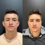 Результаты отопластики до и после в Dr. Alexandro Aguilera - Plastic Surgery, коррекция ушей
