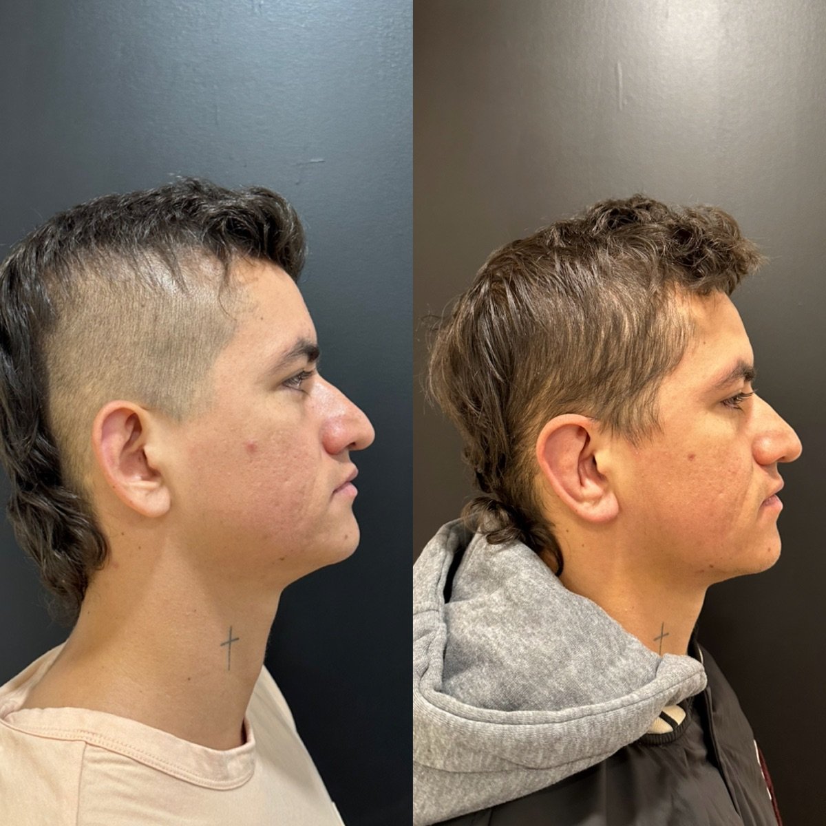 Resultados de otoplastia antes y después en Dr. Alexandro Aguilera - Plastic Surgery, corrección de orejas
