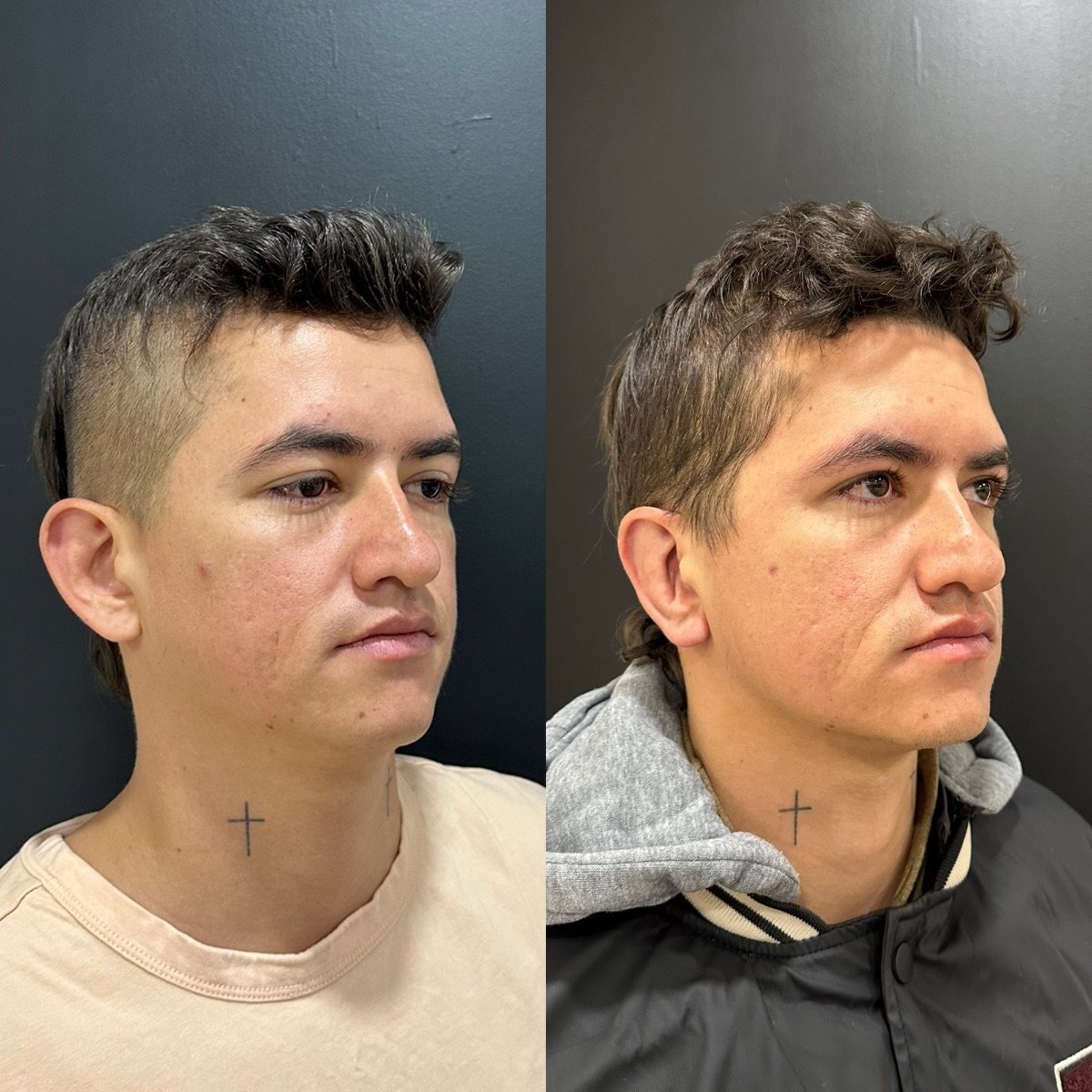 Resultados de otoplastia antes y después en Dr. Alexandro Aguilera - Plastic Surgery, corrección de orejas