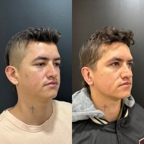 Результаты отопластики до и после в Dr. Alexandro Aguilera - Plastic Surgery, коррекция ушей