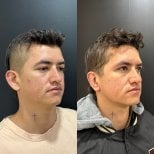Результаты отопластики до и после в Dr. Alexandro Aguilera - Plastic Surgery, коррекция ушей