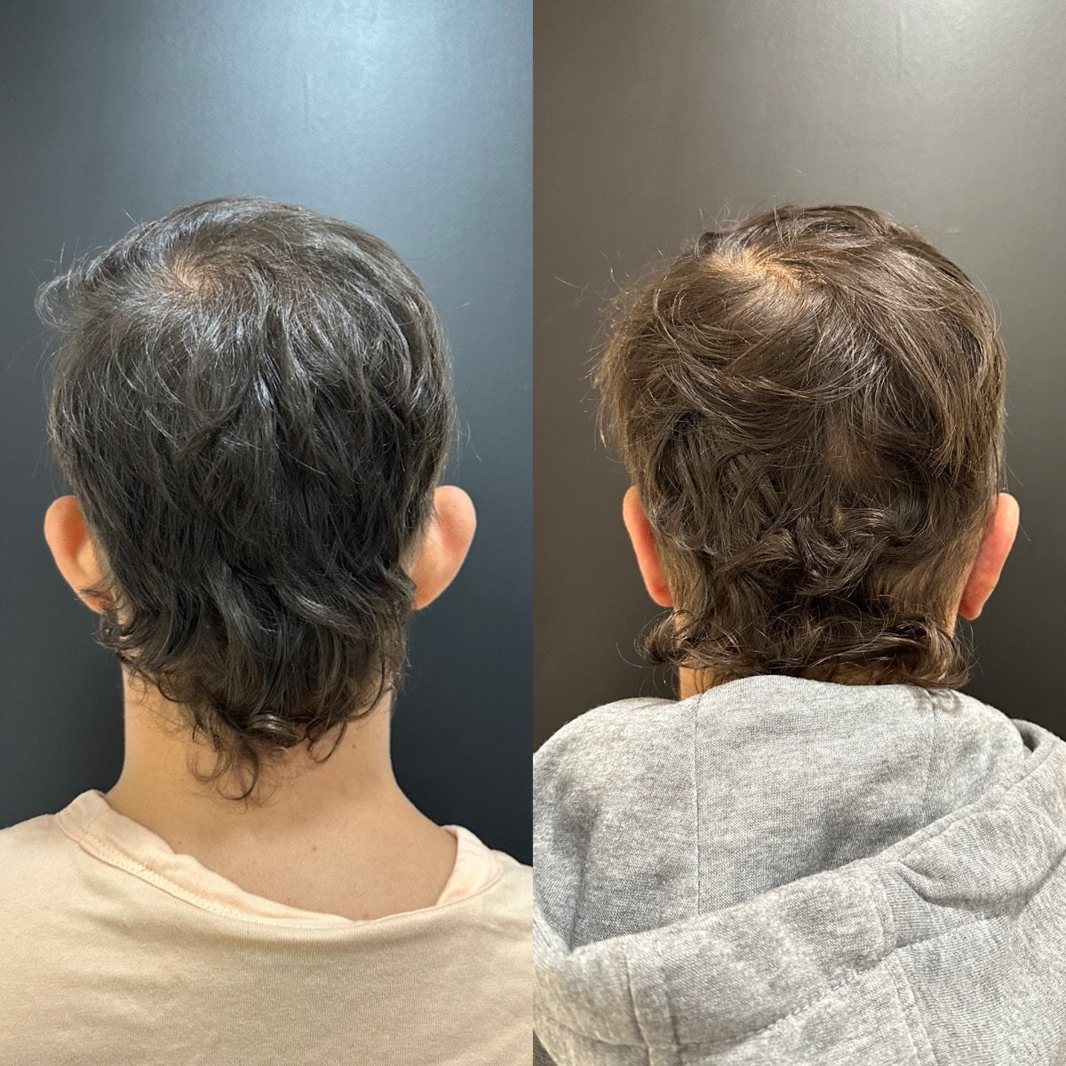 Resultados de otoplastia antes y después en Dr. Alexandro Aguilera - cirugía de orejas