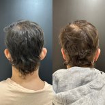 Результаты отопластики до и после в клинике Dr. Alexandro Aguilera - коррекция ушей