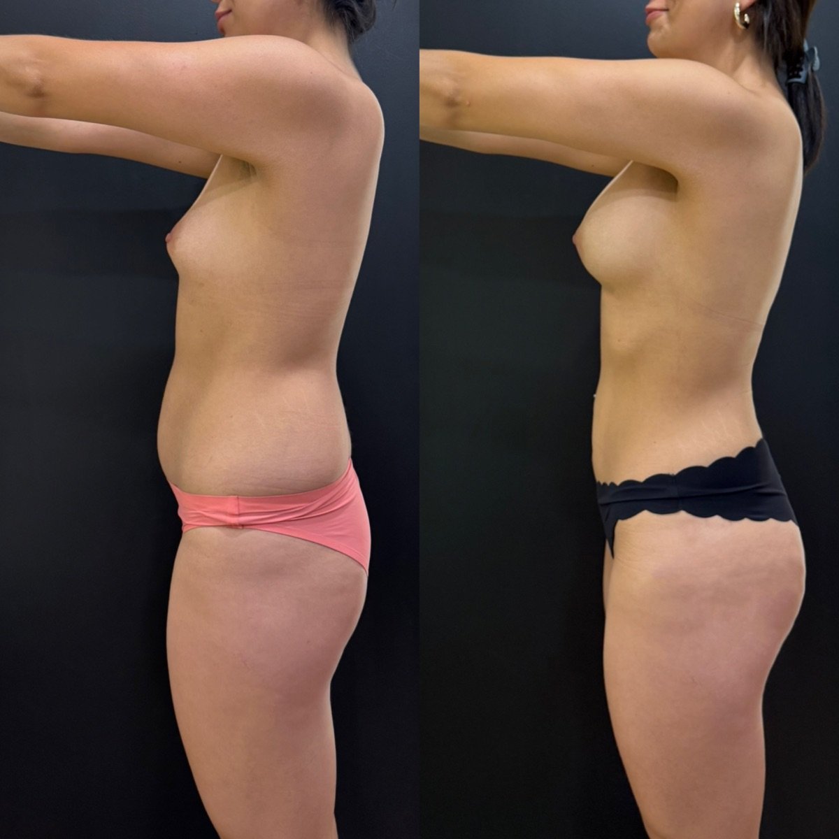 Before and after liposuction results at Dr. Alexandro Aguilera - Plastic Surgery, body contouring