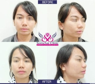 Before and after alarplasty results at Somchai Clinic, nose reshaping with refined nostrils